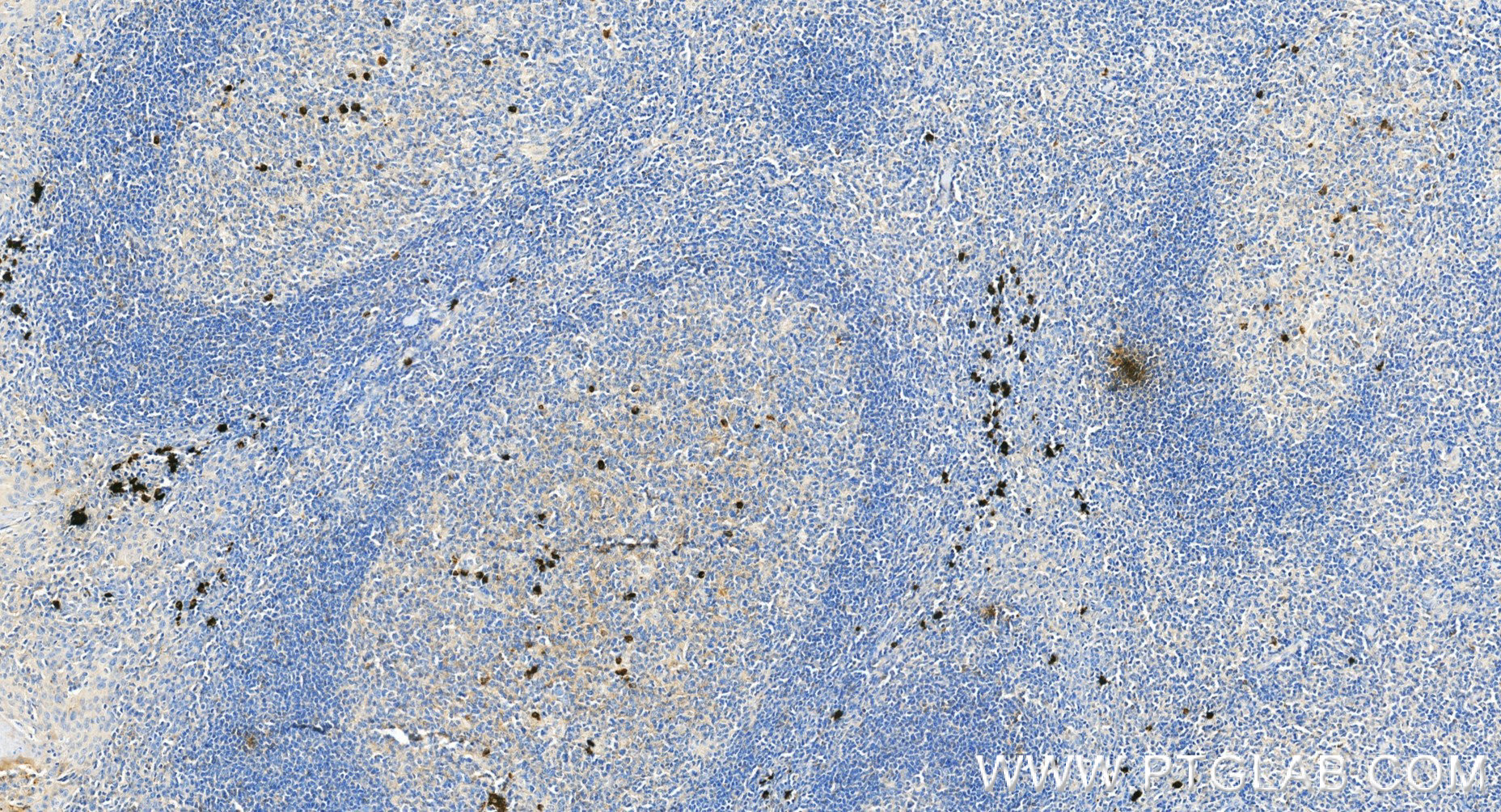 IHC staining of human tonsillitis using 87680-2-RR IHC staining of human tonsillitis using 87680-2-RR