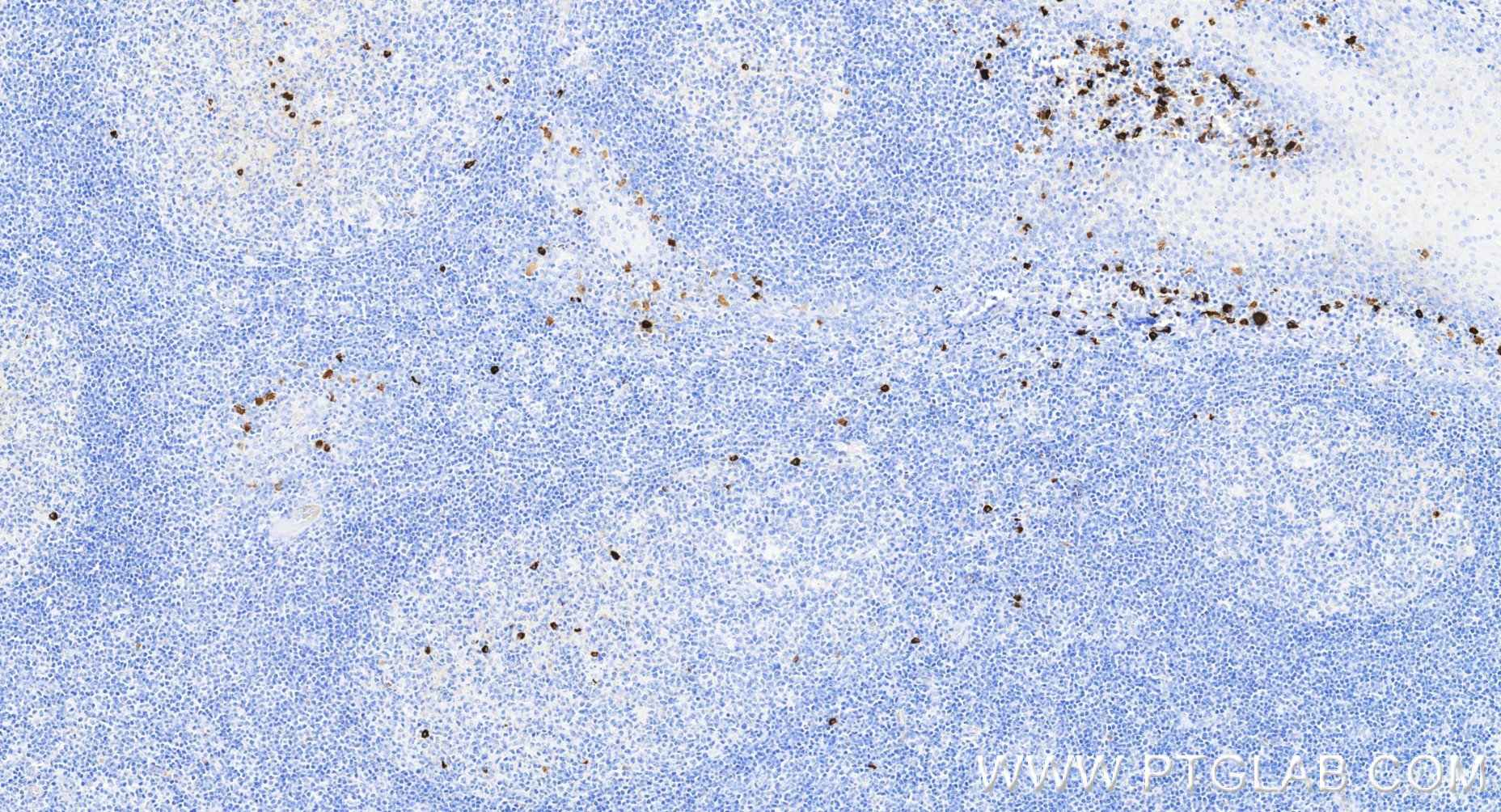 IHC staining of human tonsillitis using 87680-2-RR IHC staining of human tonsillitis using 87680-2-RR