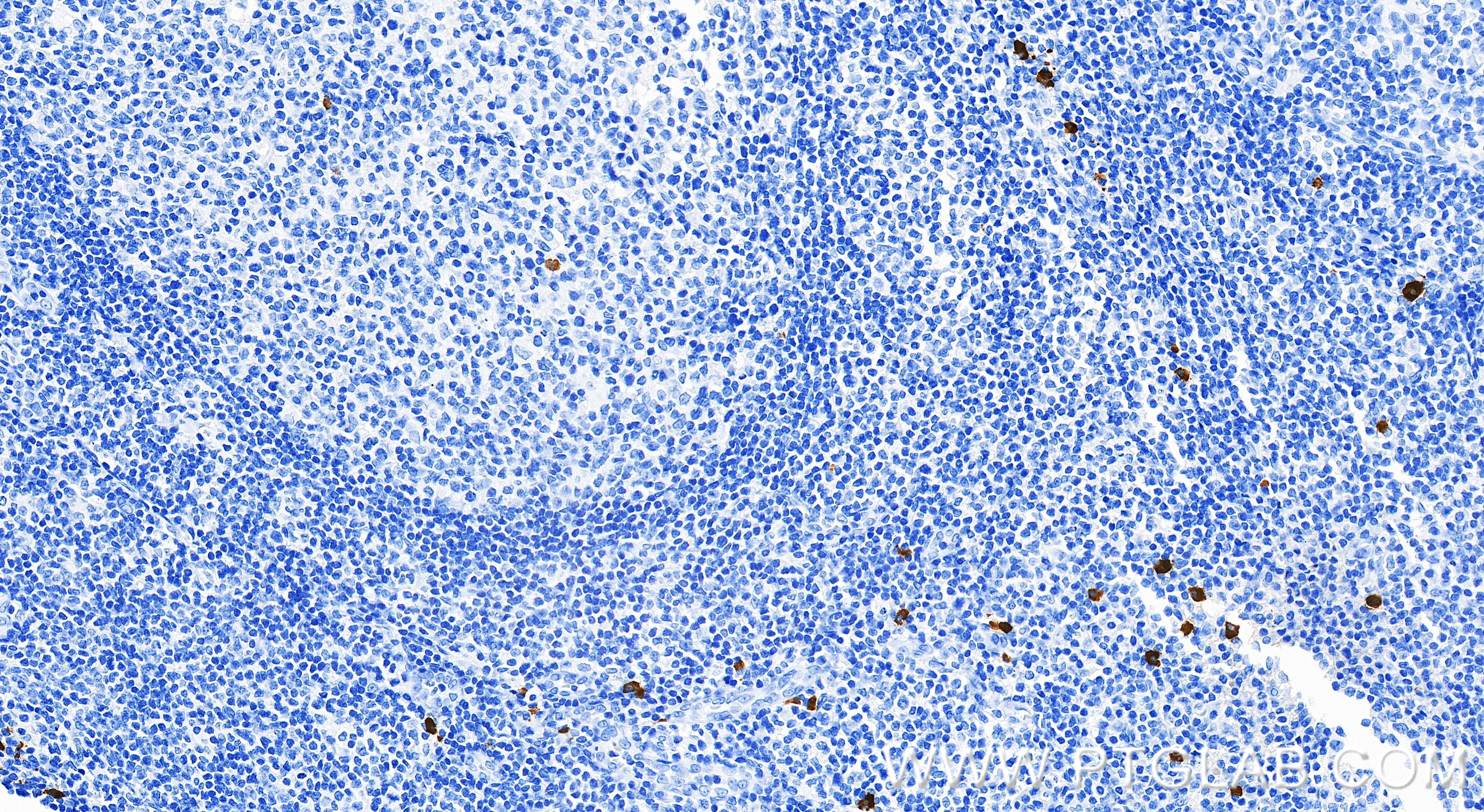 IHC staining of human tonsillitis using 87606-3-RR IHC staining of human tonsillitis using 87606-3-RR