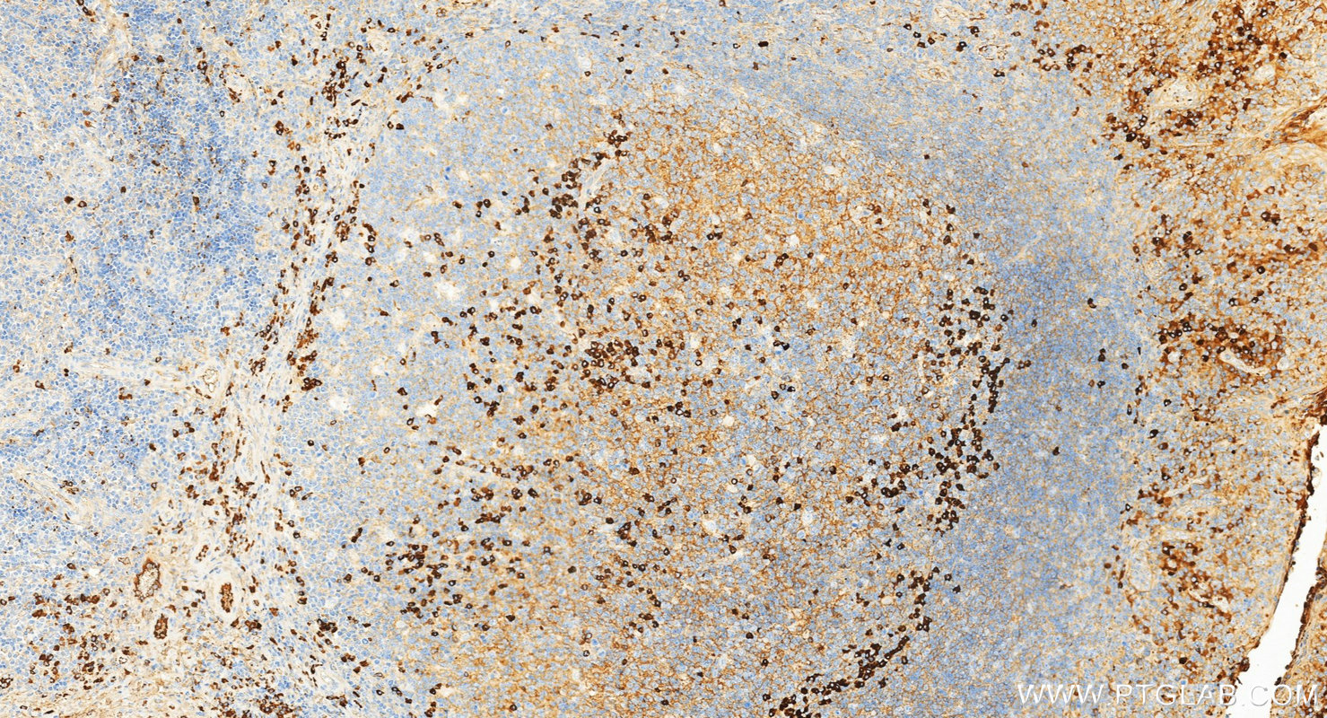 IHC staining of human tonsillitis using 10284-1-AP