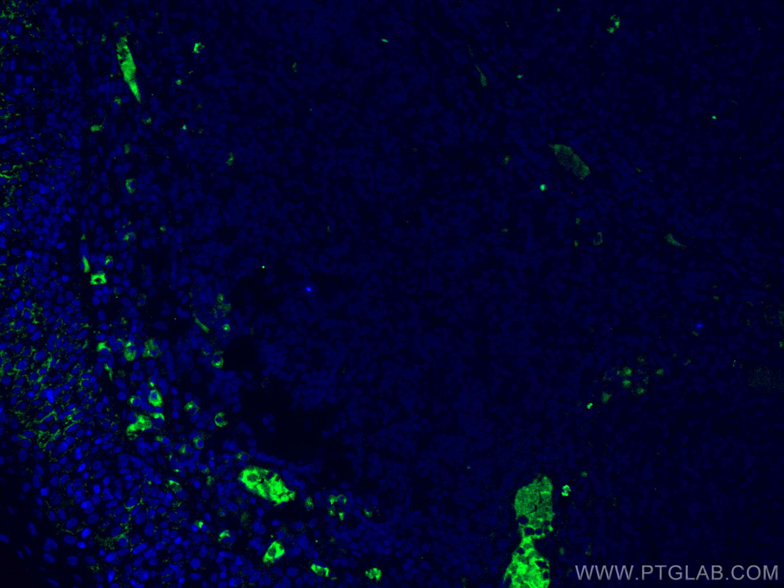 IF Staining of human tonsillitis using 67760-1-Ig (same clone as 67760-1-PBS)