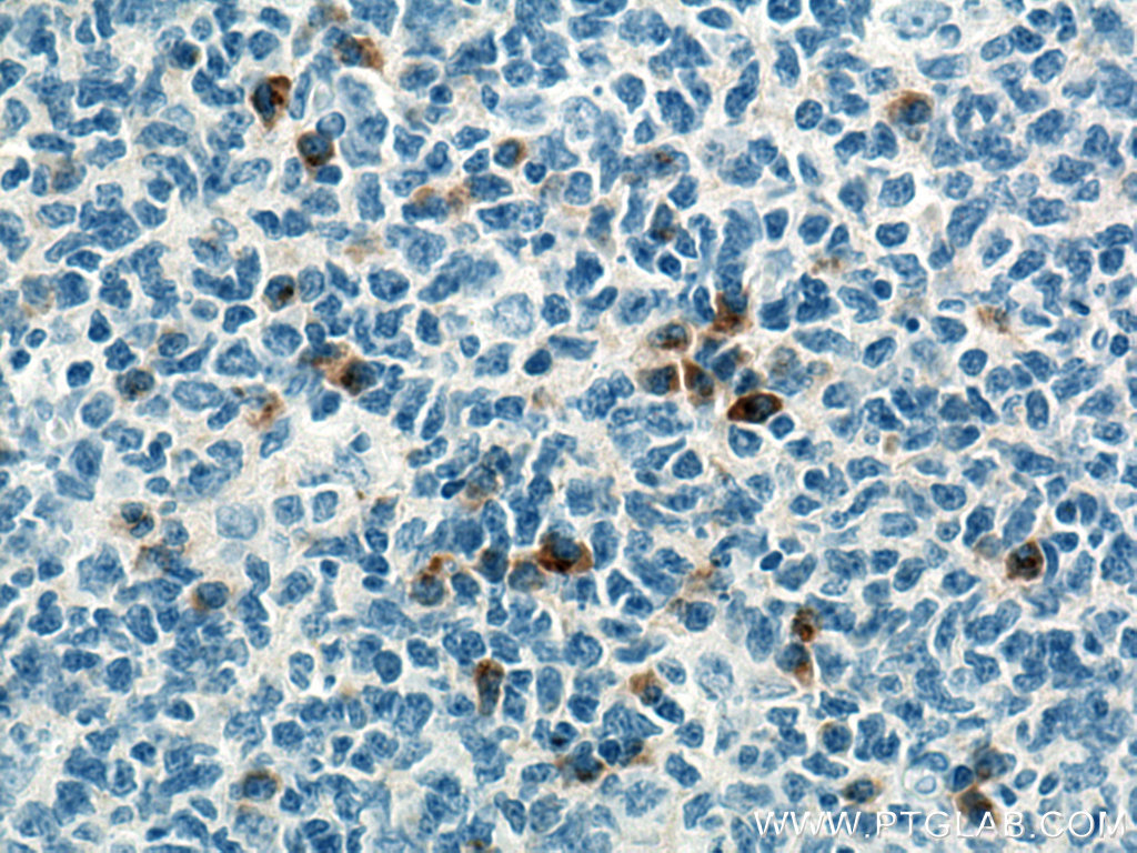 IHC staining of human tonsillitis using 67760-1-Ig (same clone as 67760-1-PBS)