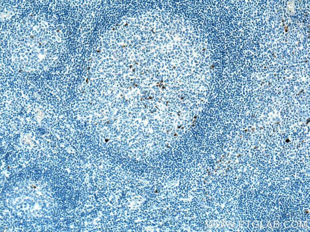 IHC staining of human tonsillitis using 67760-1-Ig (same clone as 67760-1-PBS)
