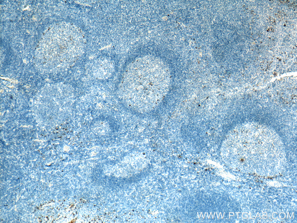 IHC staining of human tonsillitis using 67760-1-Ig (same clone as 67760-1-PBS)