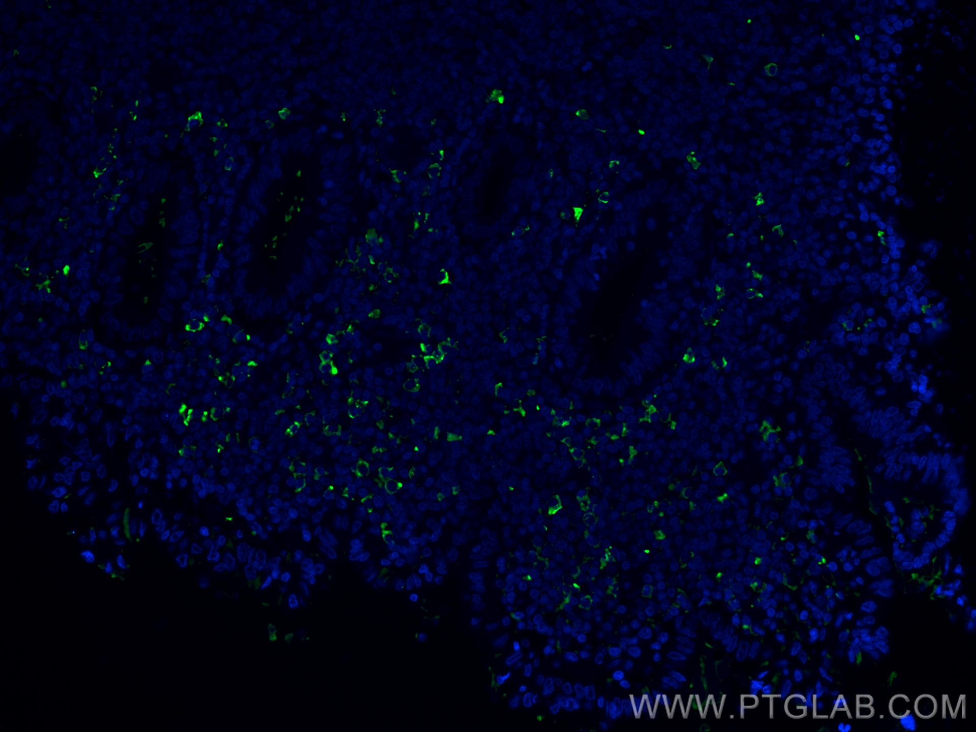 IF Staining of human appendicitis using 67762-1-Ig