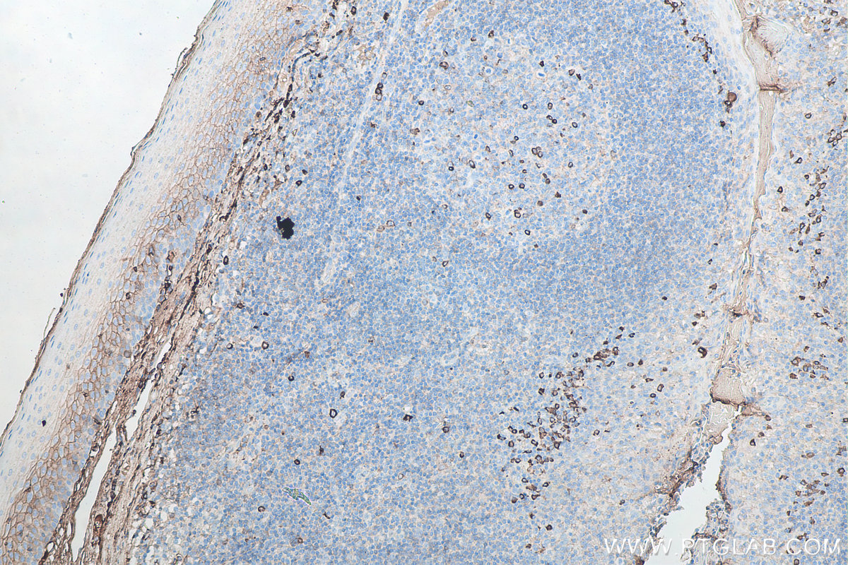 IHC staining of human tonsillitis using 67762-1-Ig