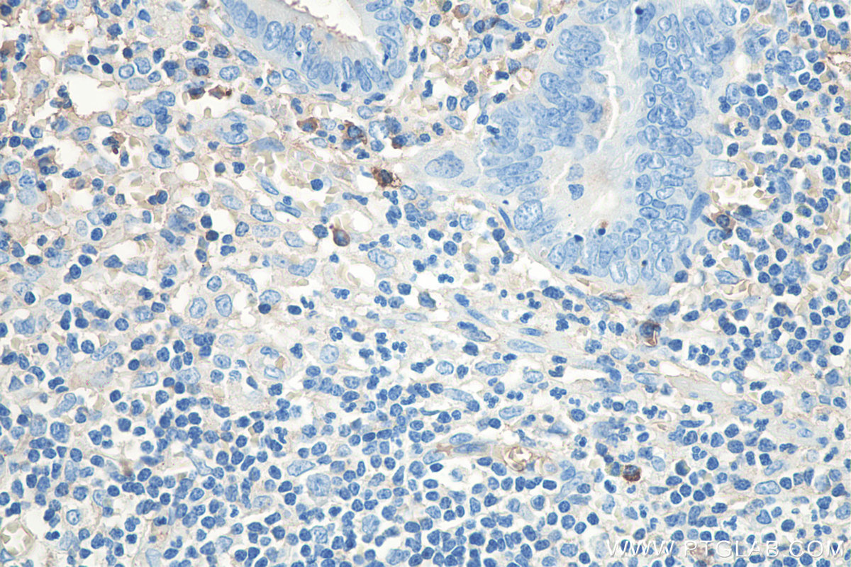 IHC staining of human appendicitis using 67762-1-Ig