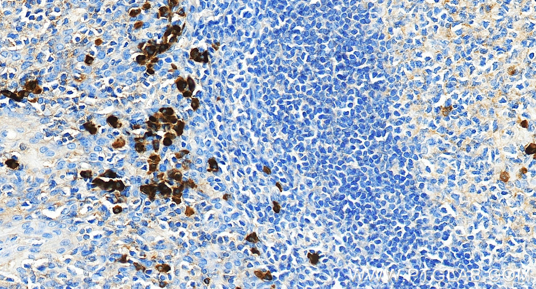 IHC staining of human tonsillitis using 98804-3-RR (same clone as 98804-3-PBS) IHC staining of human tonsillitis using 98804-3-RR (same clone as 98804-3-PBS)