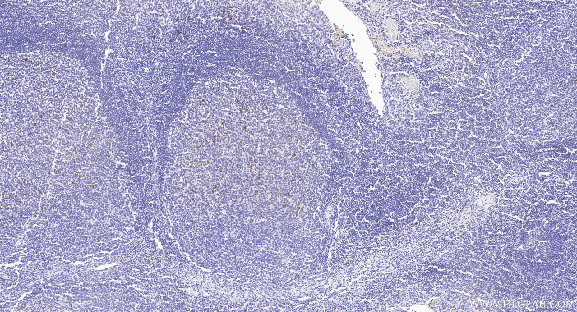 IHC staining of human tonsillitis using 87380-1-RR IHC staining of human tonsillitis using 87380-1-RR