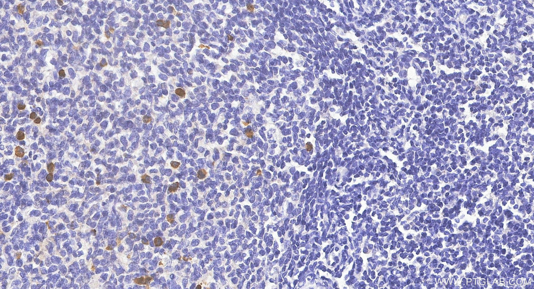 IHC staining of human tonsillitis using 87380-1-RR IHC staining of human tonsillitis using 87380-1-RR