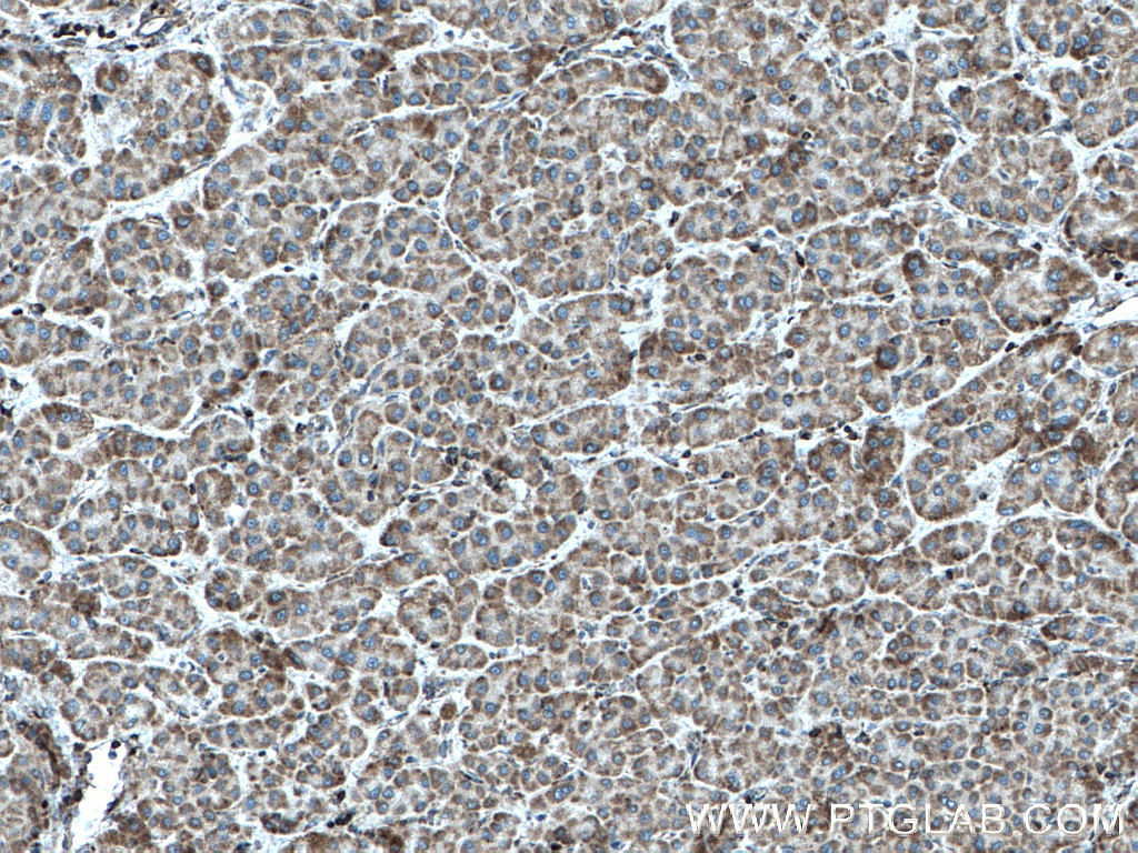 IHC staining of human liver cancer using 17170-1-AP