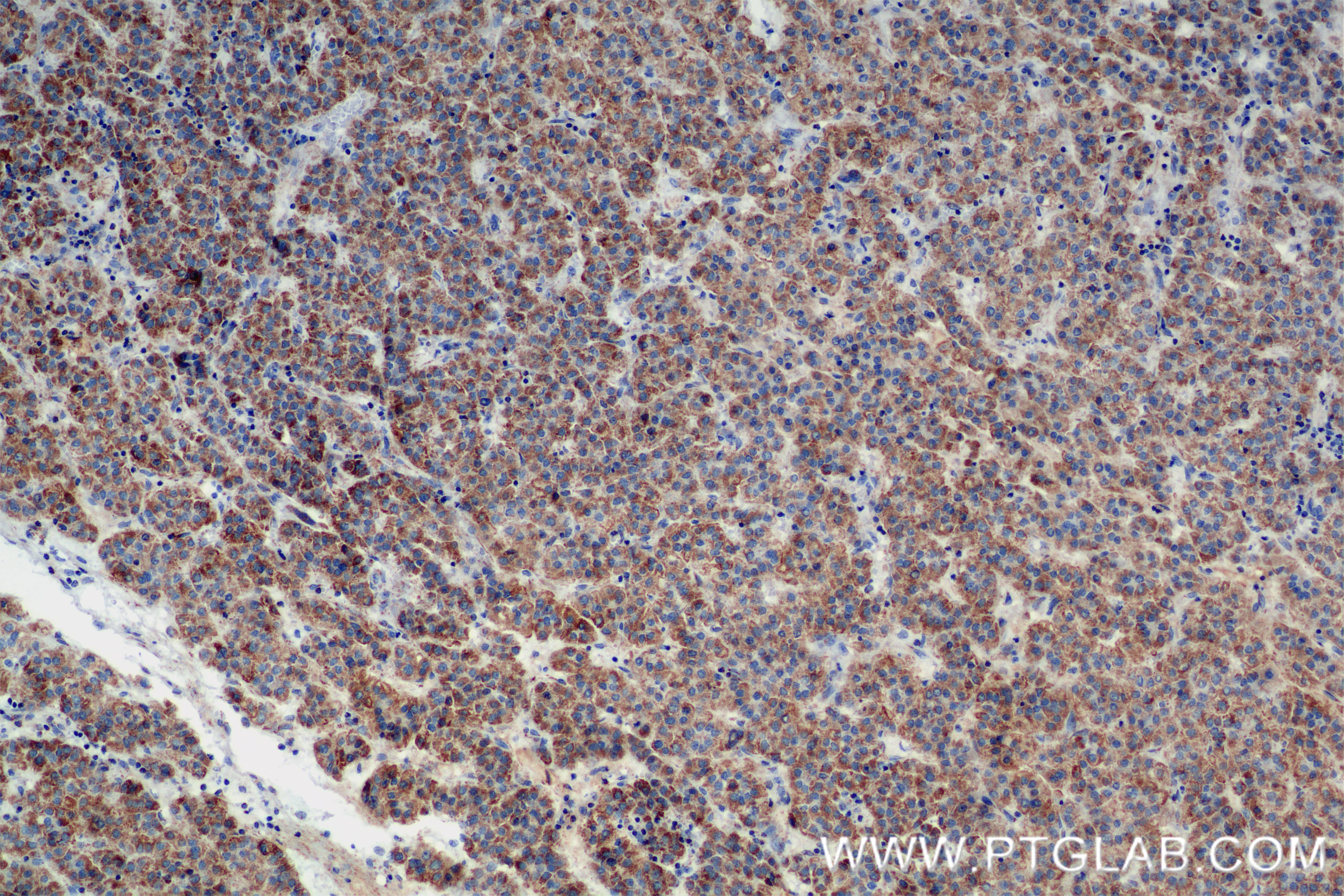 IHC staining of Human Hepatocellular cancer using 84764-3-RR (same clone as 84764-3-PBS)