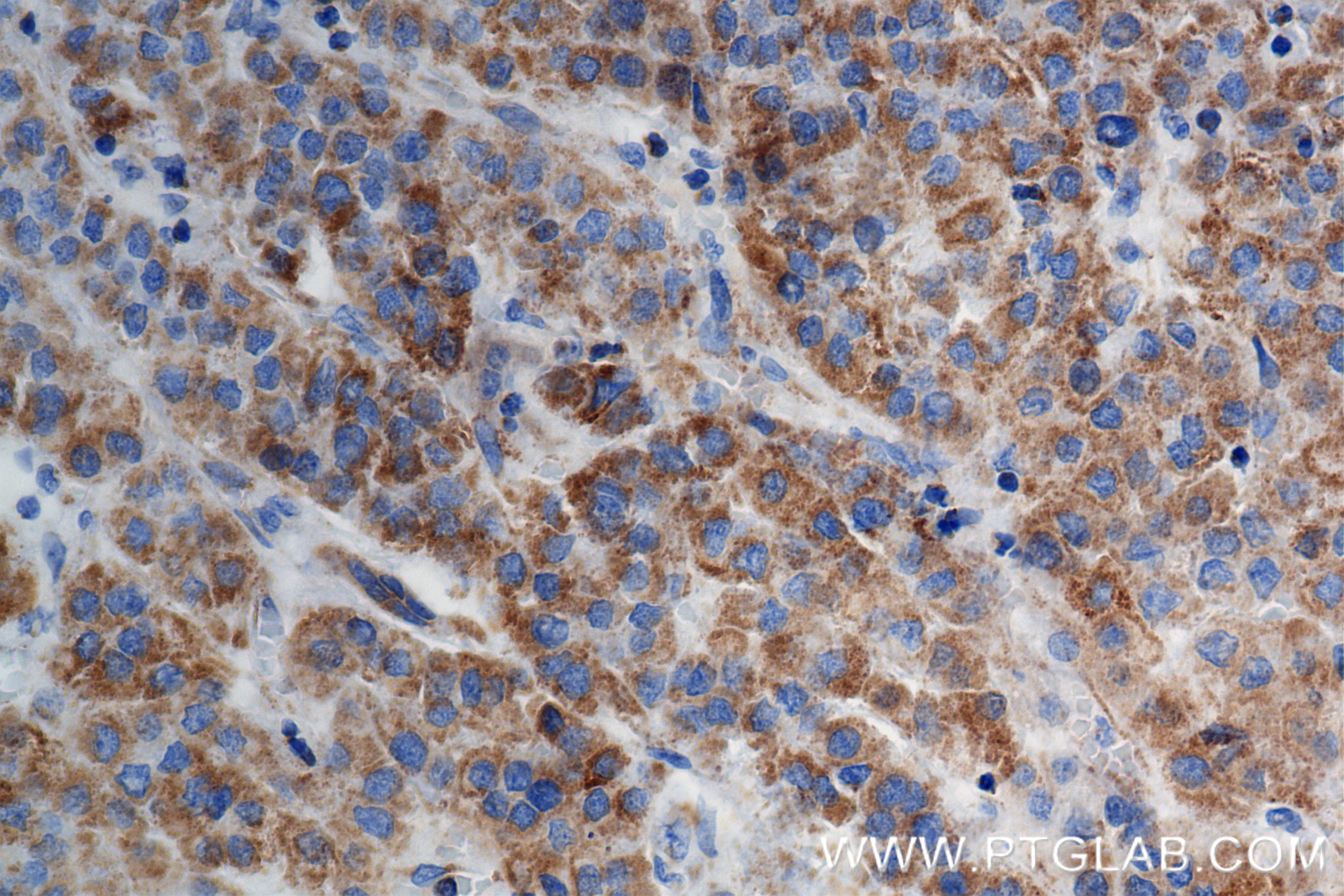 IHC staining of Human Hepatocellular cancer using 84764-3-RR (same clone as 84764-3-PBS)
