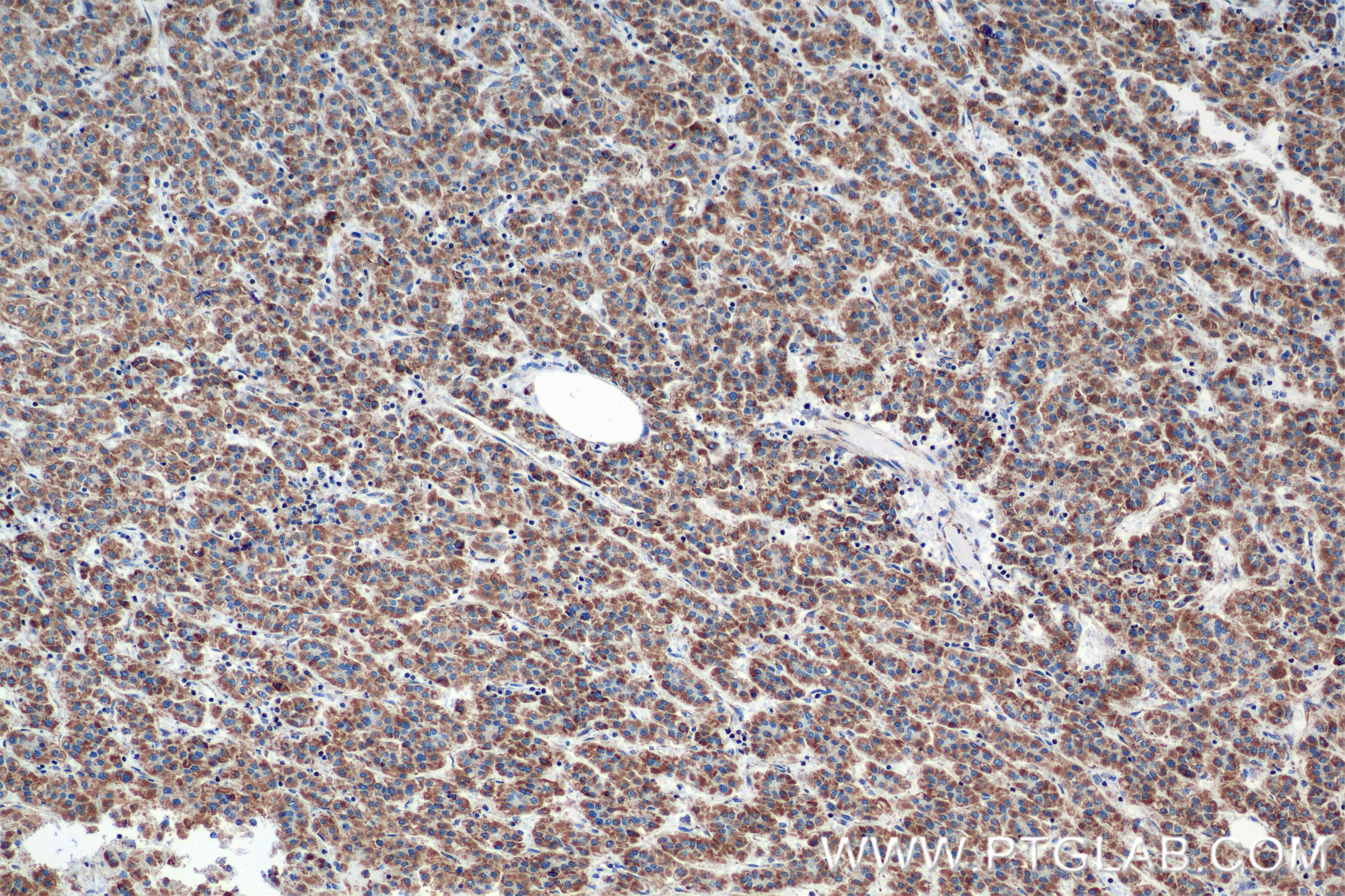 IHC staining of human hepatocellular cancer using 84764-5-RR