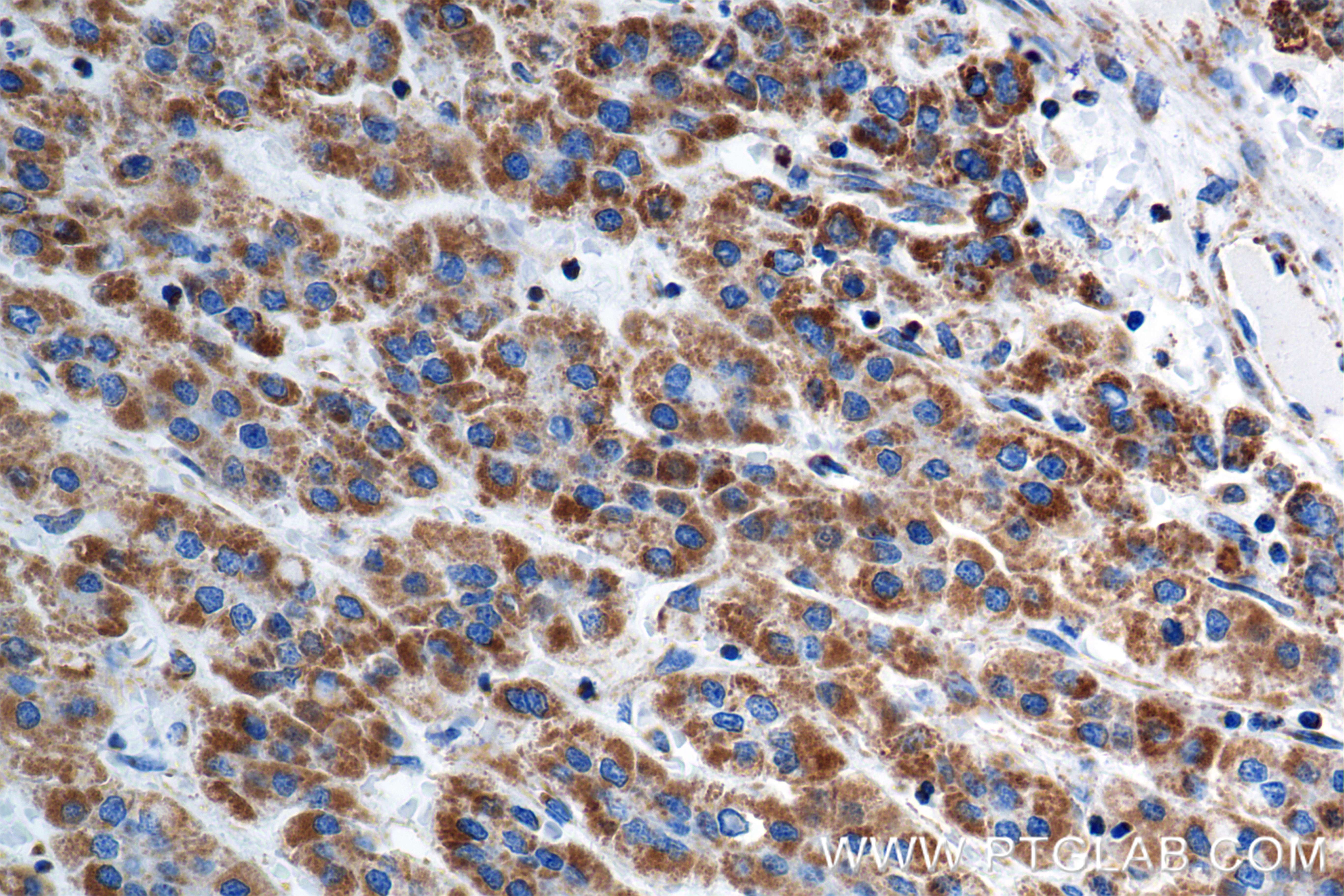 IHC staining of human hepatocellular cancer using 84764-5-RR