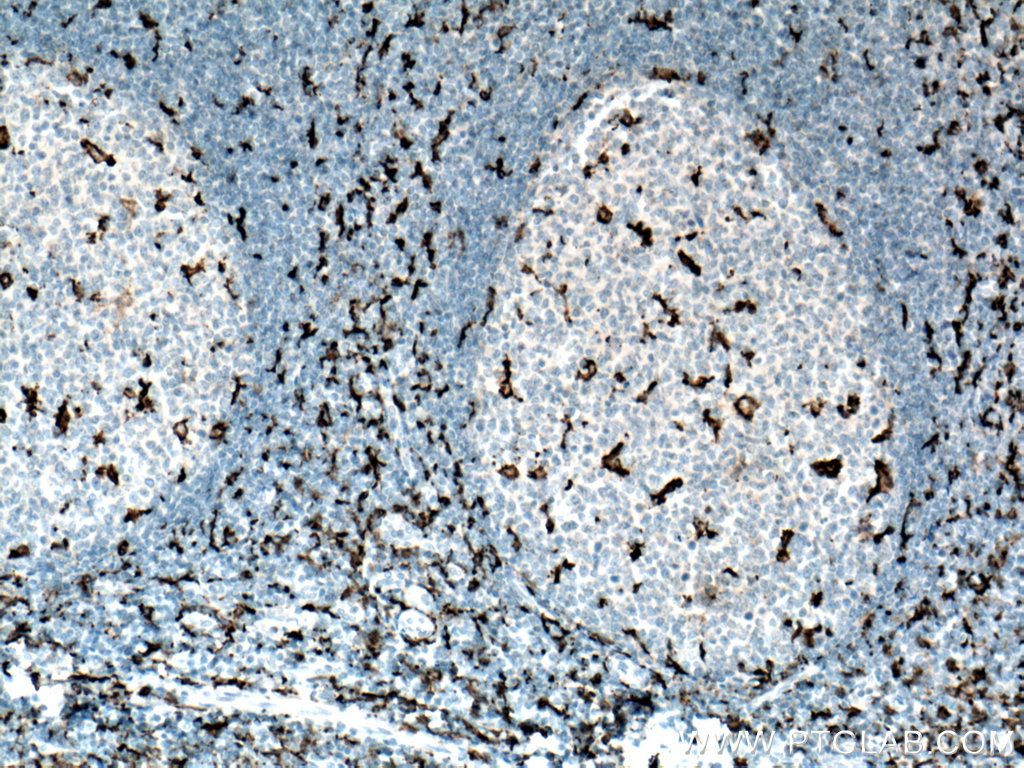 IHC staining of human tonsillitis using 66827-1-Ig