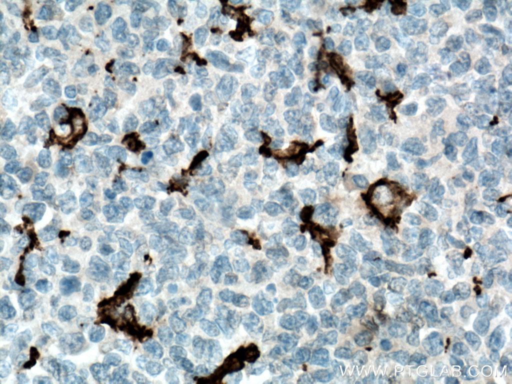 IHC staining of human tonsillitis using 66827-1-Ig