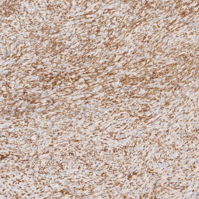 IHC staining of human gliomas using 66827-1-Ig