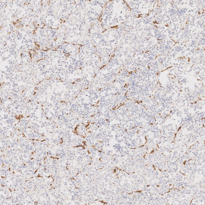 IHC staining of human pituitary adenoma using 66827-1-Ig