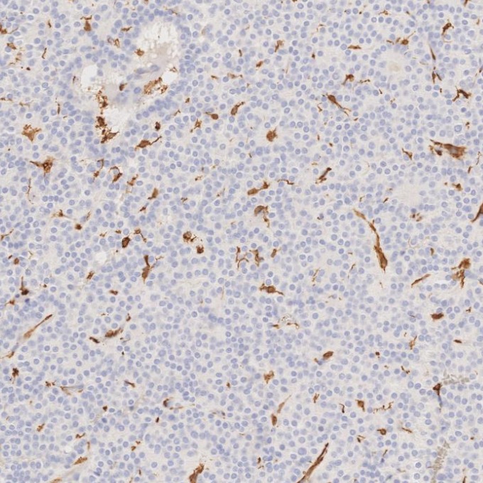 IHC staining of human pituitary adenoma using 66827-1-Ig
