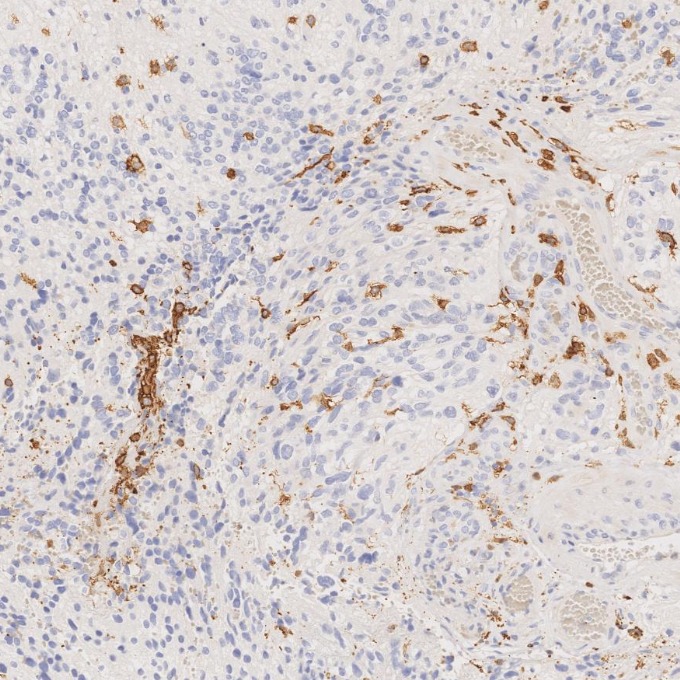 IHC staining of human gliomas using 66827-1-Ig