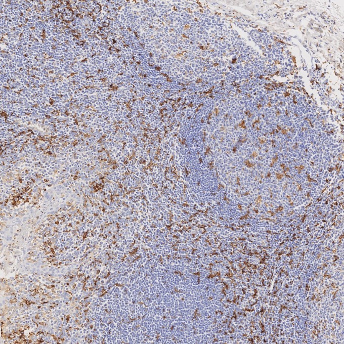 IHC staining of human tonsillitis using 66827-1-Ig
