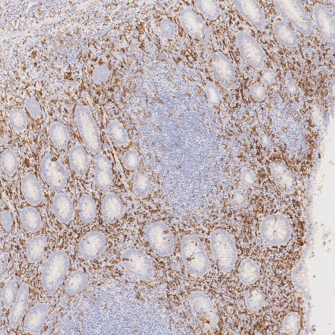 IHC staining of human appendicitis using 66827-1-Ig