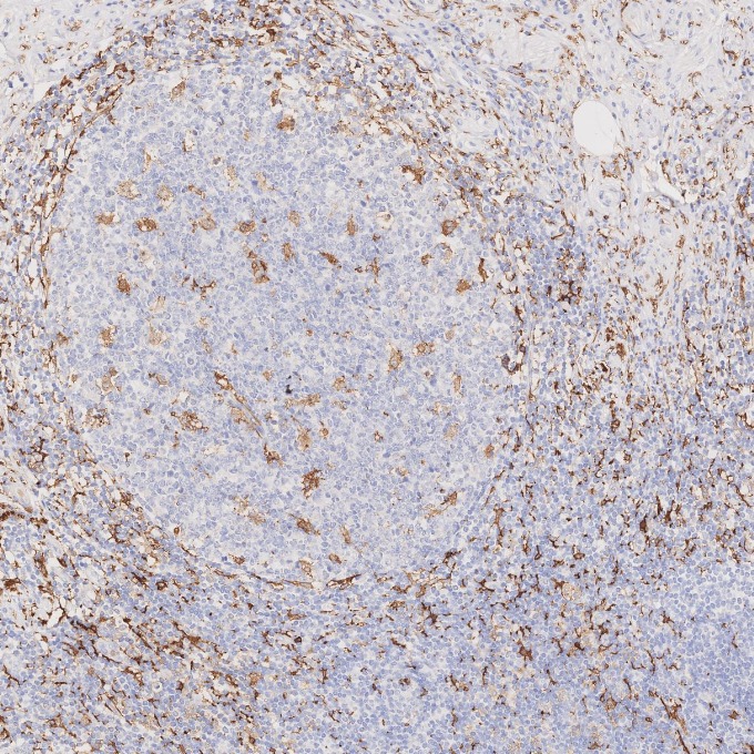 IHC staining of human appendicitis using 66827-1-Ig