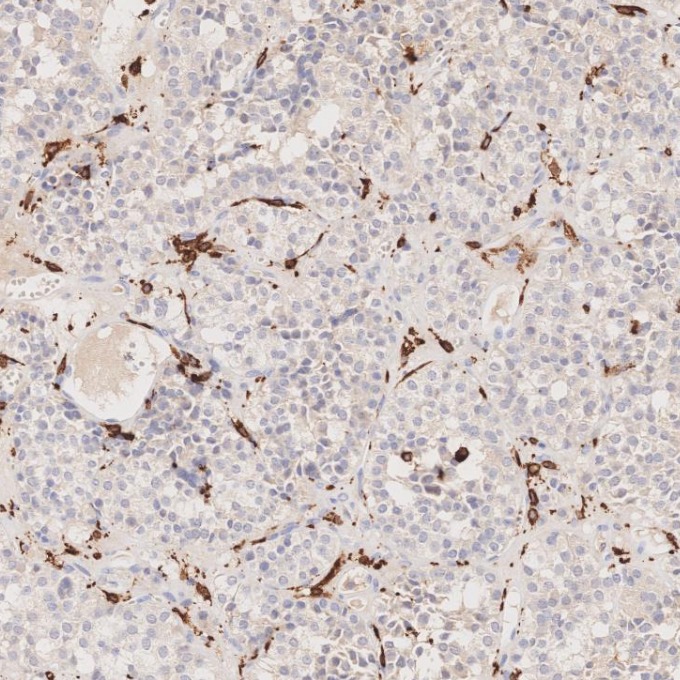 IHC staining of human pituitary adenoma using 66827-1-Ig