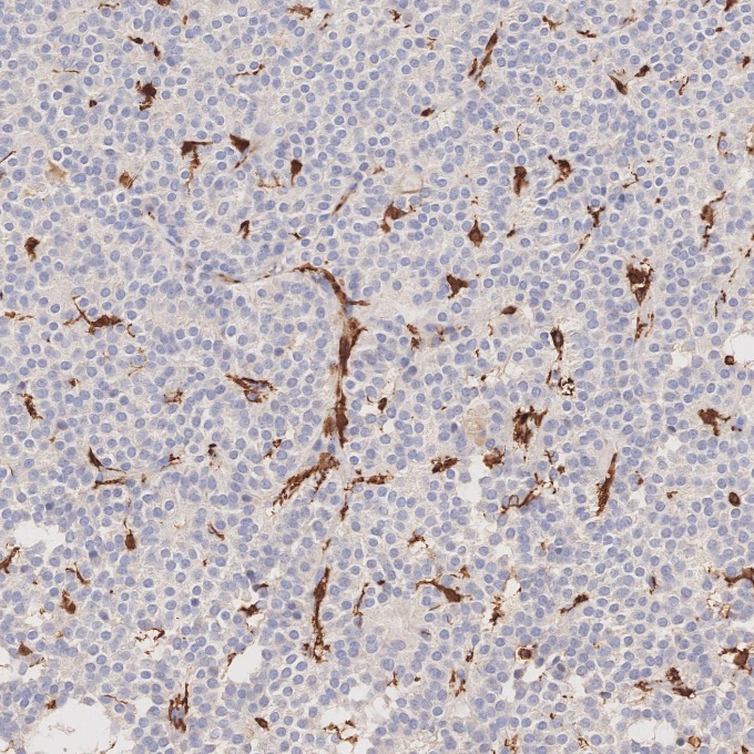IHC staining of human pituitary adenoma using 66827-1-Ig