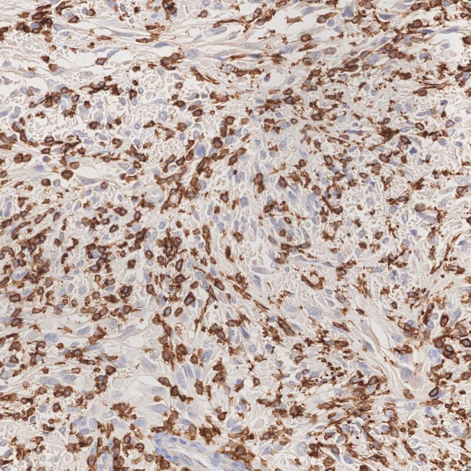 IHC staining of human gliomas using 66827-1-Ig