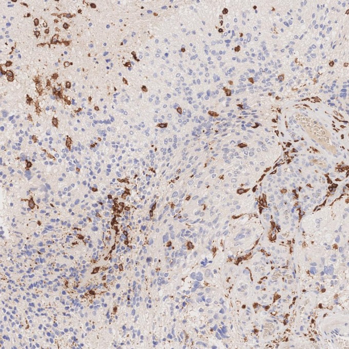 IHC staining of human gliomas using 66827-1-Ig