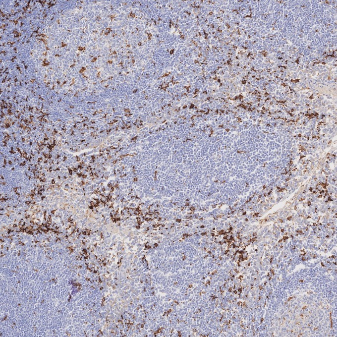 IHC staining of human tonsillitis using 66827-1-Ig