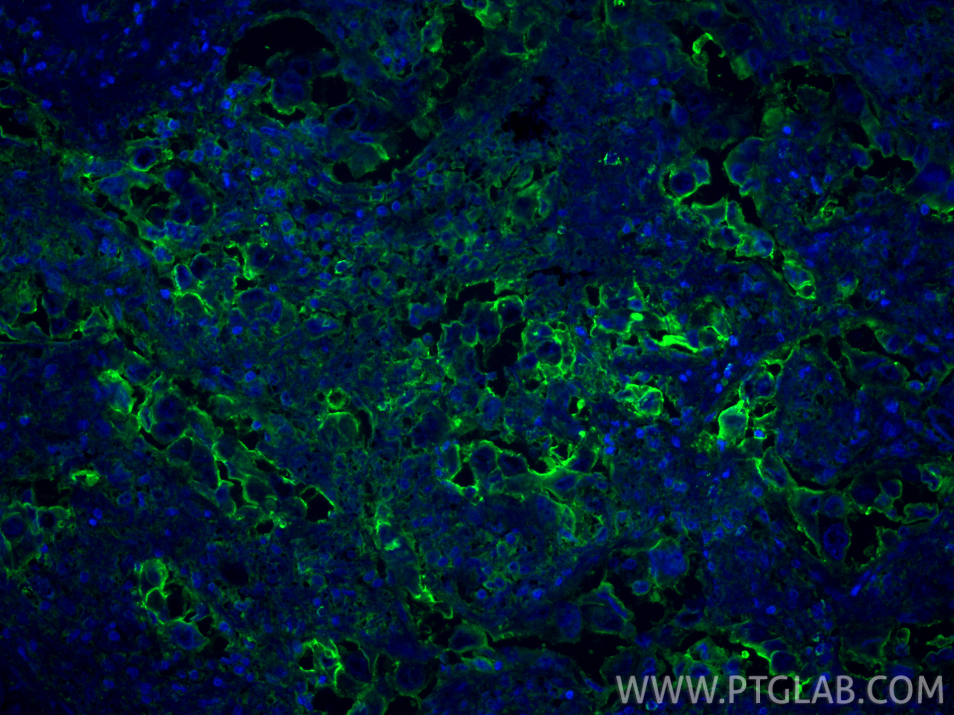 IF Staining of human lung cancer using 10831-1-AP IF Staining of human lung cancer using 10831-1-AP