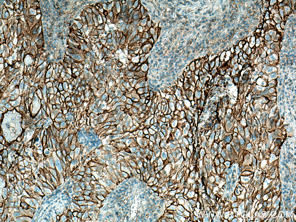 IHC staining of human lung cancer using 10831-1-AP