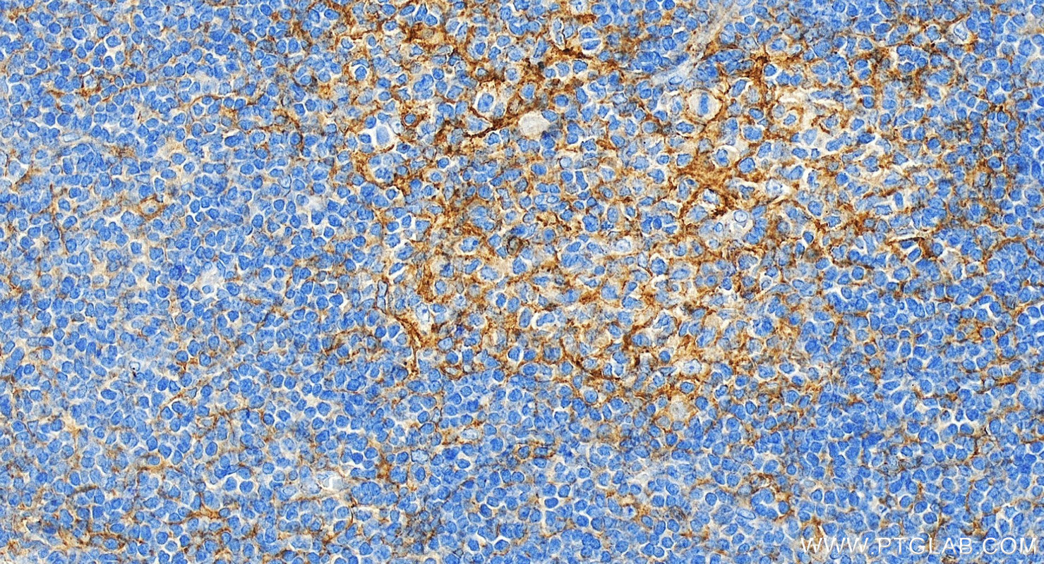 IHC staining of human tonsillitis using 10831-1-AP
