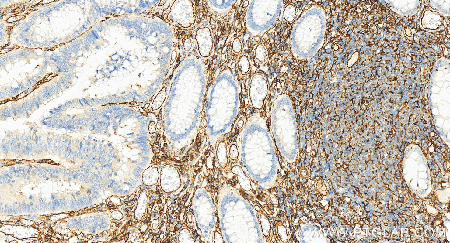 Immunohistochemical analysis of paraffin-embedded human colon cancer tissue slide using 15364-1-AP (ICAM-1/CD54 antibody) at dilution of 1:2000 (under 20x lens). Heat mediated antigen retrieval with Tris-EDTA buffer (pH 9.0). IHC staining of human colon cancer using 15364-1-AP