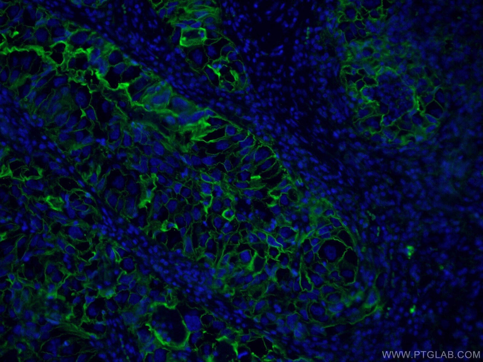 IF Staining of human lung cancer using 60299-1-Ig