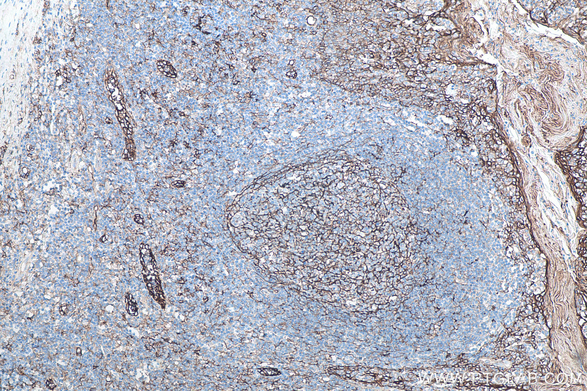 IHC staining of human tonsillitis using 60299-1-Ig IHC staining of human tonsillitis using 60299-1-Ig