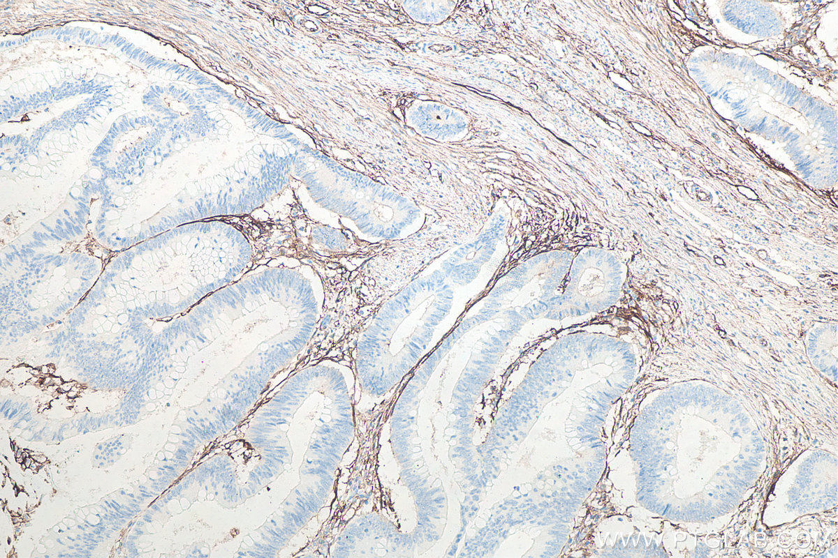 IHC staining of human colon cancer using 60299-1-Ig IHC staining of human colon cancer using 60299-1-Ig