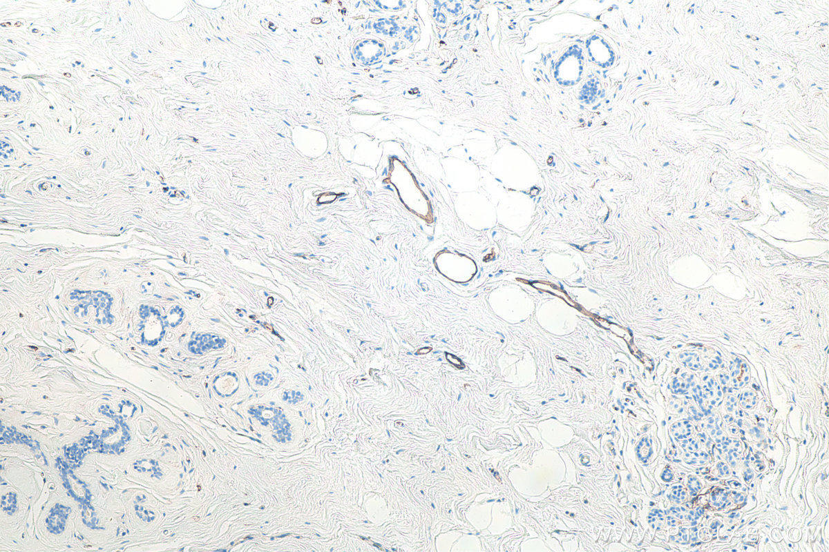 IHC staining of human breast cancer using 60299-1-Ig IHC staining of human breast cancer using 60299-1-Ig