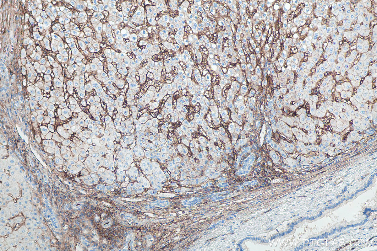IHC staining of human liver cancer using 60299-1-Ig IHC staining of human liver cancer using 60299-1-Ig