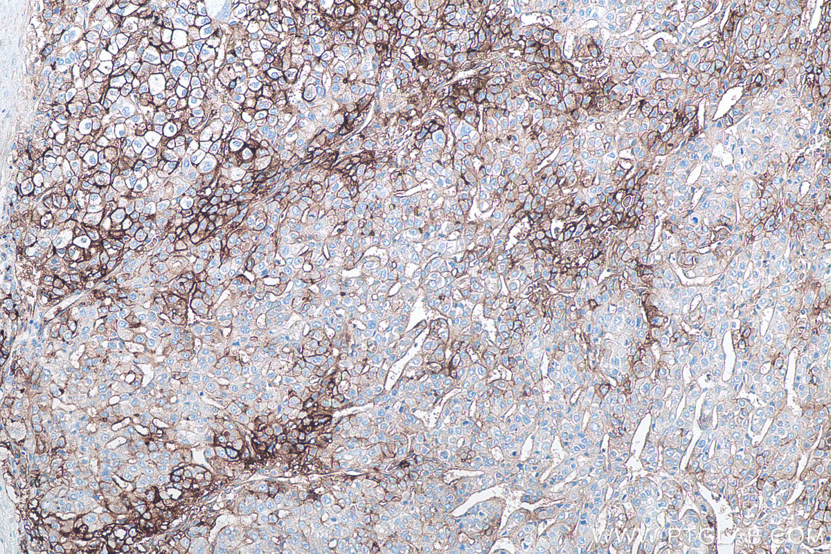 IHC staining of human liver cancer using 60299-1-Ig IHC staining of human liver cancer using 60299-1-Ig