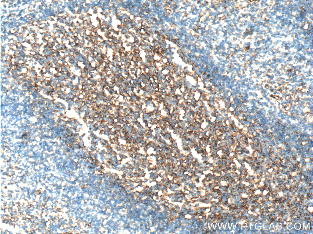 IHC staining of human tonsillitis using 60299-1-Ig