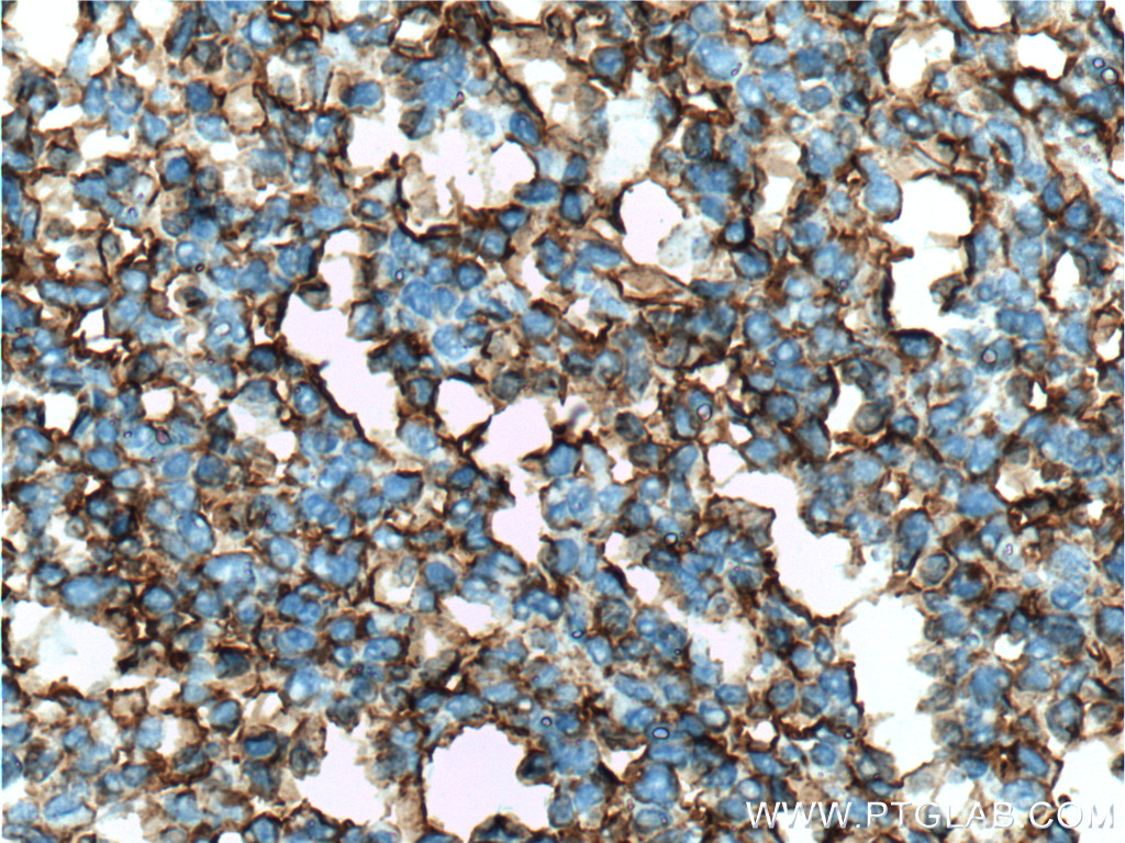 IHC staining of human tonsillitis using 60299-1-Ig