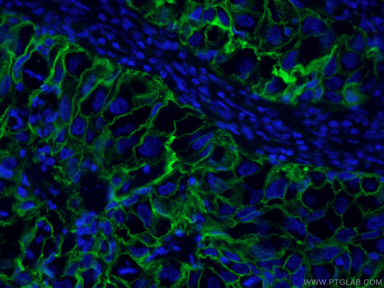 IF Staining of human lung cancer using CL488-60299