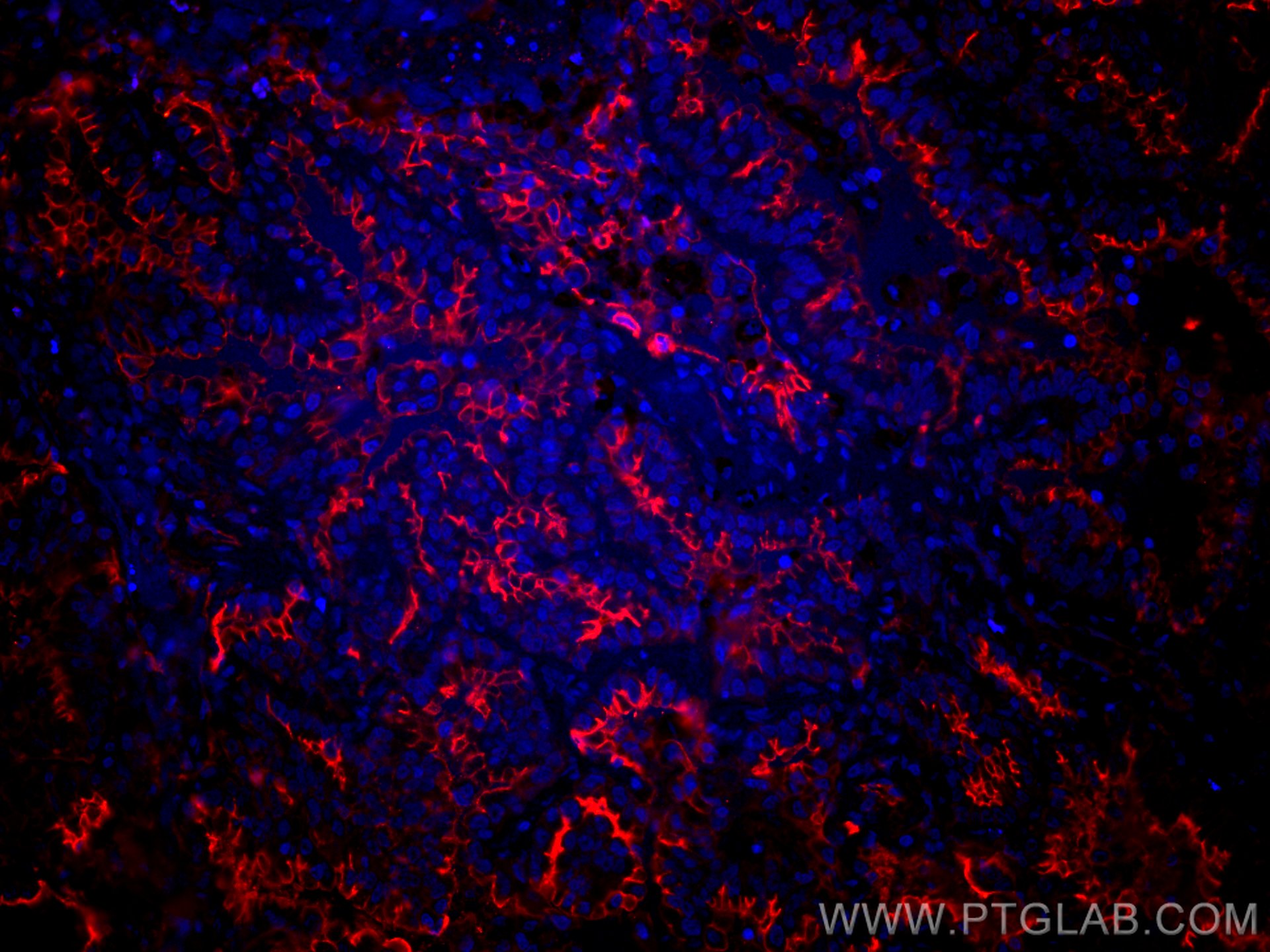 IF Staining of human lung cancer using CL594-10831