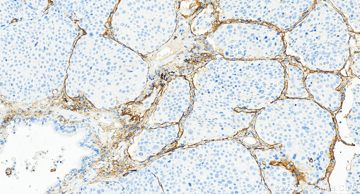 IHC staining of human lung squamous cell carcinoma using RMX00016