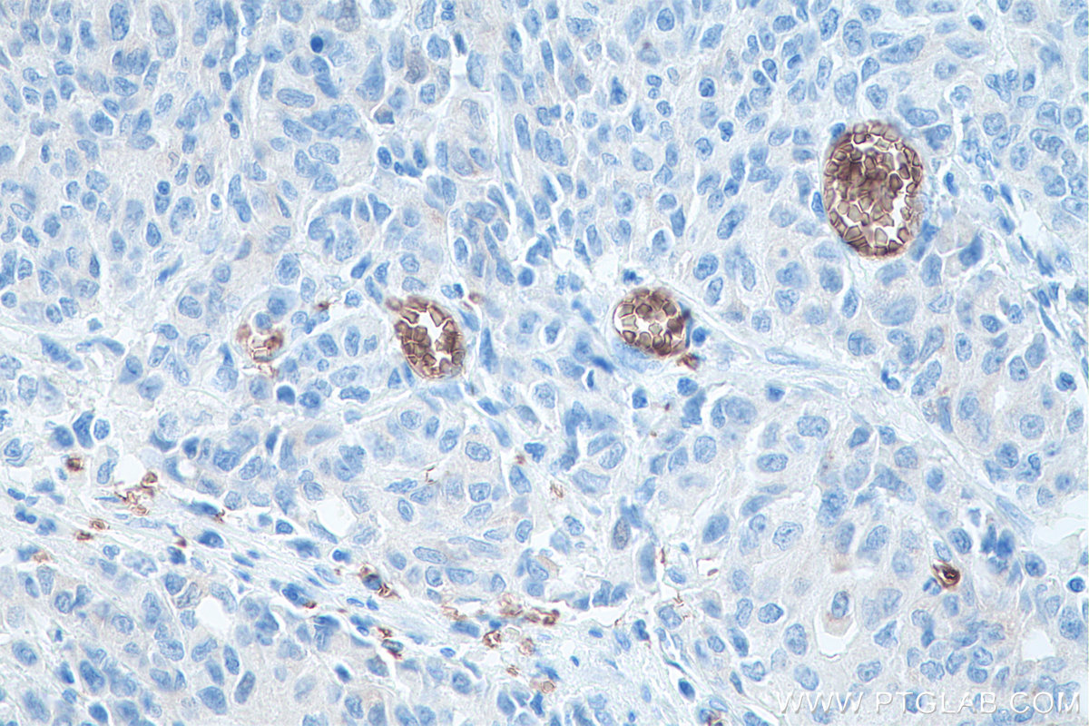 IHC staining of human stomach cancer using 67014-1-Ig