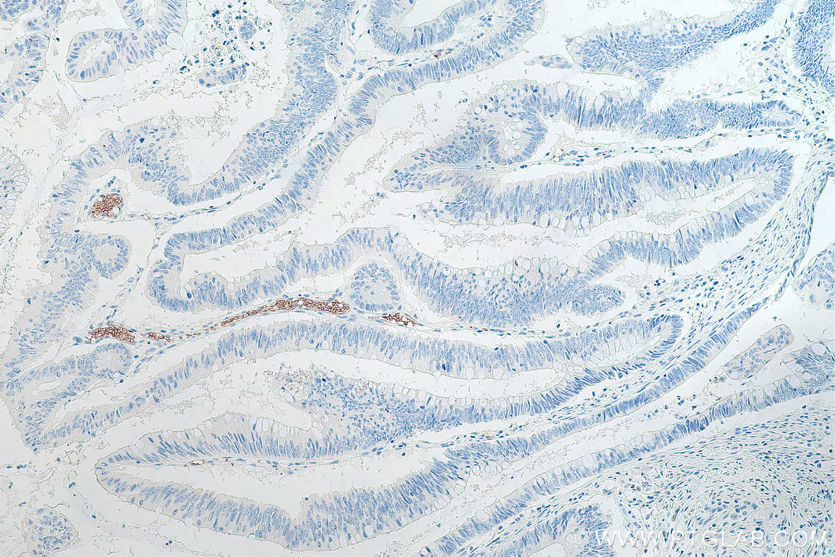 IHC staining of human colon cancer using 67014-1-Ig